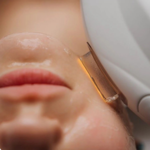 Woman receiving an IPL treatment